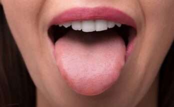 Sour tongue