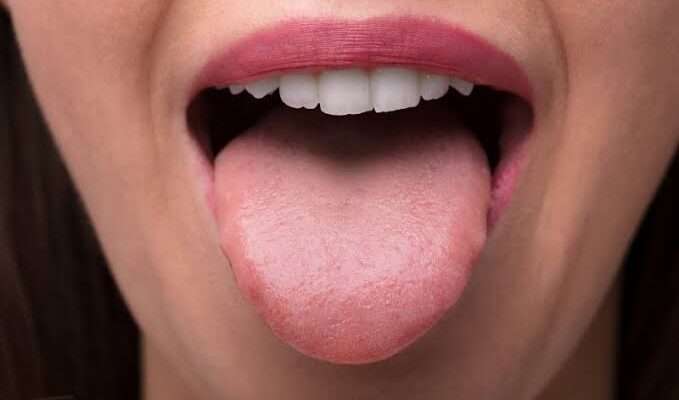 Sour tongue